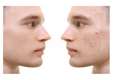 Acne Treatments service in Randwick