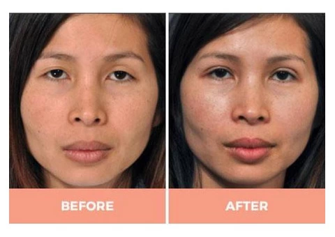 Lower Eyelid Blepharoplasty in Sydney by Dr. Hodgkinson - Visit Us Now!