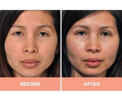 Lower Eyelid Blepharoplasty in Sydney by Dr. Hodgkinson - Visit Us Now!