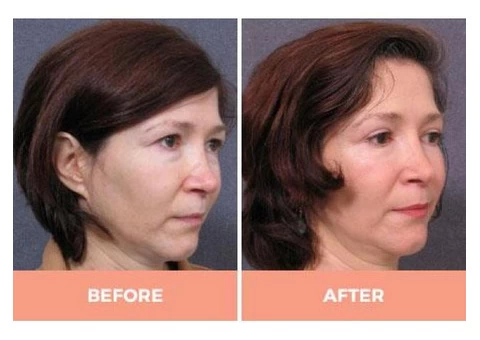 Lower Eyelid Blepharoplasty in Sydney by Dr. Hodgkinson - Visit Us Now! - 2/2