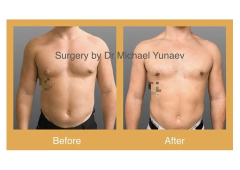 Professional Male Breast Reduction Surgery in Sydney - Contact Us Now!