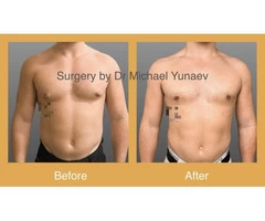 Professional Male Breast Reduction Surgery in Sydney - Contact Us Now!