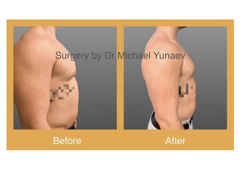 Professional Male Breast Reduction Surgery in Sydney - Contact Us Now! - 2/2