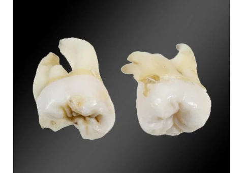 Check Out Wisdom Teeth Removal Melbourne