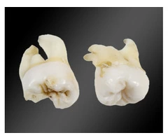 Check Out Wisdom Teeth Removal Melbourne