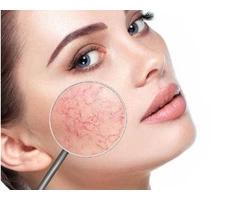 Rosacea Treatment Adelaide