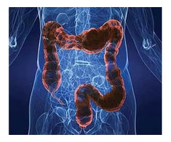 Colon Cleanse Clinic in Sydney