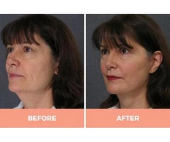 High-Quality Lower Face Lift Surgery in Sydney -  Contact Dr Hodgkinson Today!
