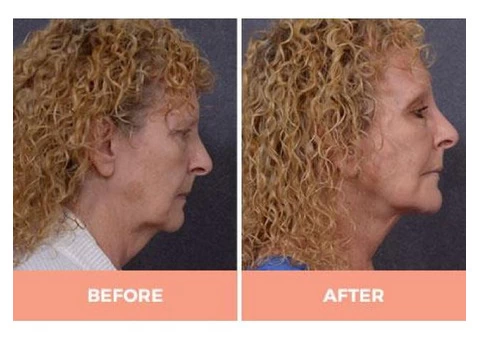 High-Quality Lower Face Lift Surgery in Sydney -  Contact Dr Hodgkinson Today! - 2/3