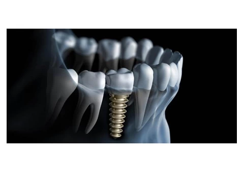 Dental Implant Carina Brisbane - Care 4 Teeth - 2/6