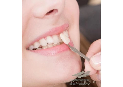 Confidence with Teeth Caps Adelaide