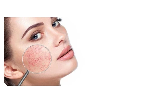 Rosacea Treatment Adelaide