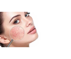 Rosacea Treatment Adelaide
