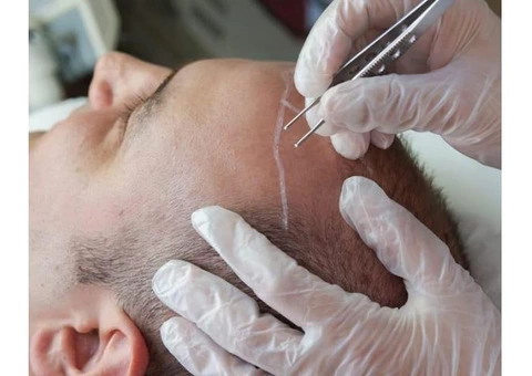 Best Hair Transplant Cost in Melbourne - 2/8