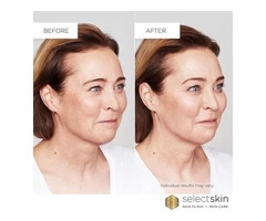 Dermal Fillers Treatment in Coogee