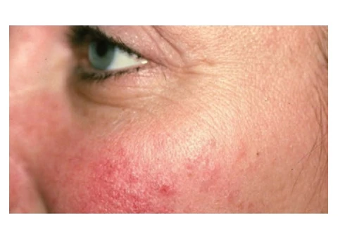 Best Laser Face Treatment in Sydney