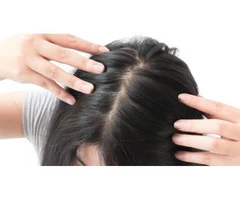 Losing Your Self Confidence Due to Female Hair Loss