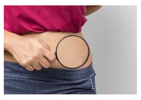 Remove Stretch Marks Through Non-Invasive Way