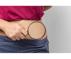 Remove Stretch Marks Through Non-Invasive Way