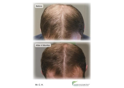 Are You Facing Hair Loss in Gold Coast?