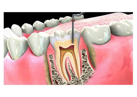 Best root canal treatment in Burnside - Parkwood Green Dental