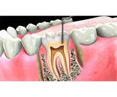 Best root canal treatment in Burnside - Parkwood Green Dental
