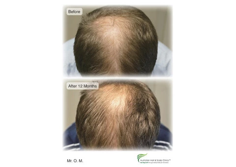 Searching for a Natural Hair Regrowth Treatment in Brisbane?