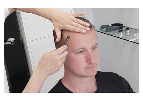Cost For Hair Loss Transplant Clinic Melbourne - 4/7