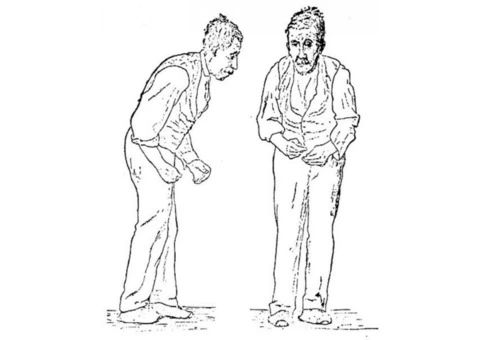 Contact us for Parkinson’s Disease Treatment