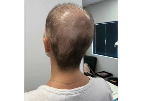 Female Hair Loss Treatment Clinic - 7/7