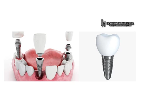 Best Teeth Implant dentistry treatment | Prahran Family Dental