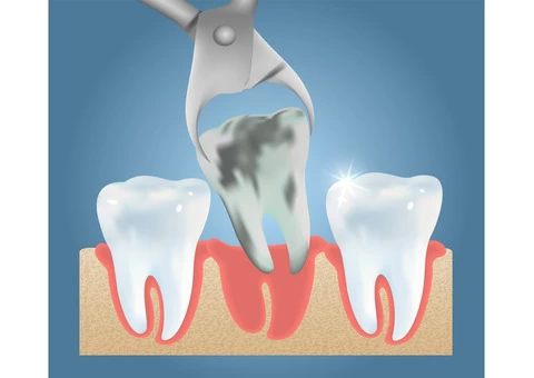 Find Out Impacted Wisdom Teeth Removal