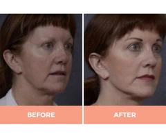 Effective Mid & Lower Facelift Surgery in Sydney By Dr. Hodgkinson - CALL US TODAY!