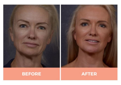 Effective Mid & Lower Facelift Surgery in Sydney By Dr. Hodgkinson - CALL US TODAY! - 3/4