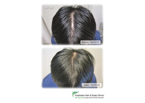 Hair Loss & Alopecia Areata Treatment Melbourne | Natural Hair Regrowth