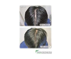 Hair Loss & Alopecia Areata Treatment Melbourne | Natural Hair Regrowth