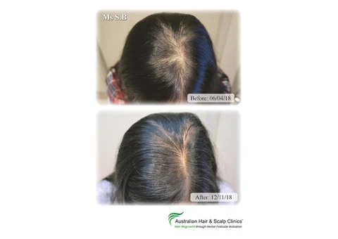 Regrow your hair with the best hair loss treatment in Sydney
