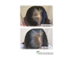 Regrow your hair with the best hair loss treatment in Sydney