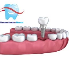 Dental Crowns and Bridges – An Effective Treatment