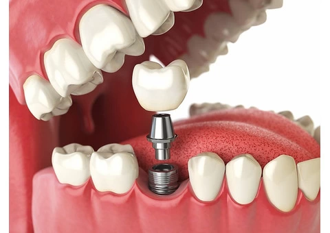 dental implants melbourne - Prosmiles Dental Studio - 1/8