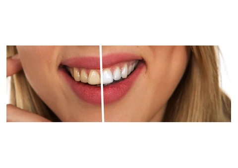 dental implants melbourne - Prosmiles Dental Studio - 2/8