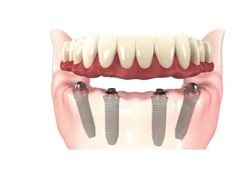 dental implants melbourne - Prosmiles Dental Studio - 7/8