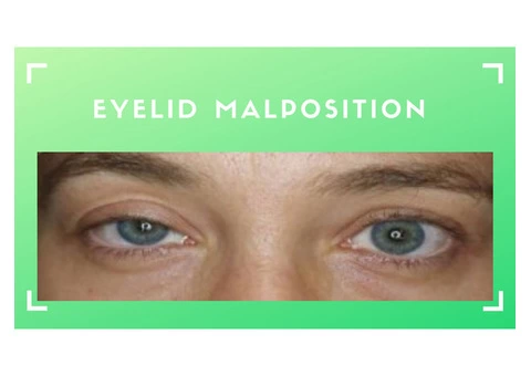 Eyelid Malposition & How to Treat It | Eye Specialist Adelaide