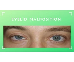 Eyelid Malposition & How to Treat It | Eye Specialist Adelaide