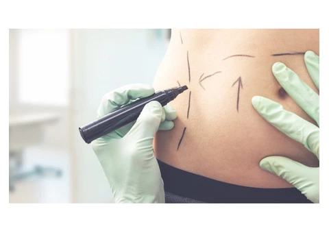 Want Tummy Tuck Plastic Surgery In Sydney