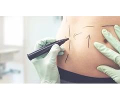 Want Tummy Tuck Plastic Surgery In Sydney