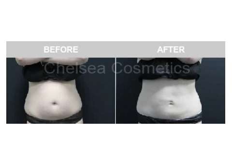 Get A Great Body With Chelsea Cosmetics' Liposuction Surgery in Melbourne - Contact Us Today! - 3/5