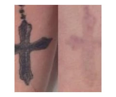 Laser Tattoo Removal in Melbourne | Doff and Flux