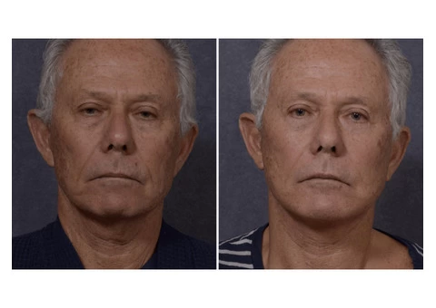 Expert Face Surgery in Sydney By Renowned Facial Surgeon Dr Hodgkinson - Contact Us! - 1/4