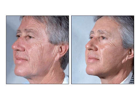 Expert Face Surgery in Sydney By Renowned Facial Surgeon Dr Hodgkinson - Contact Us! - 2/4